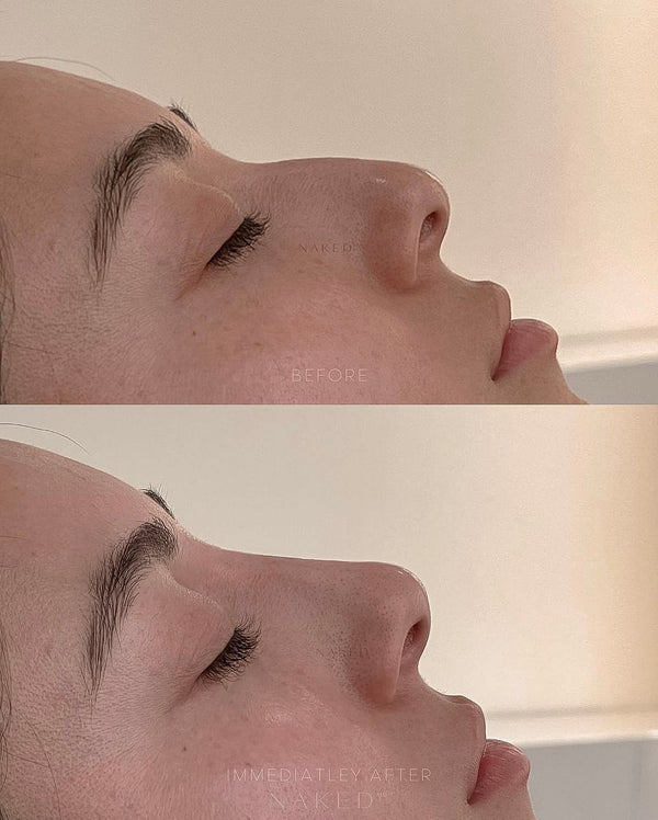 Naked Nose | Non-Surgical Nose Job (NSNJ)
