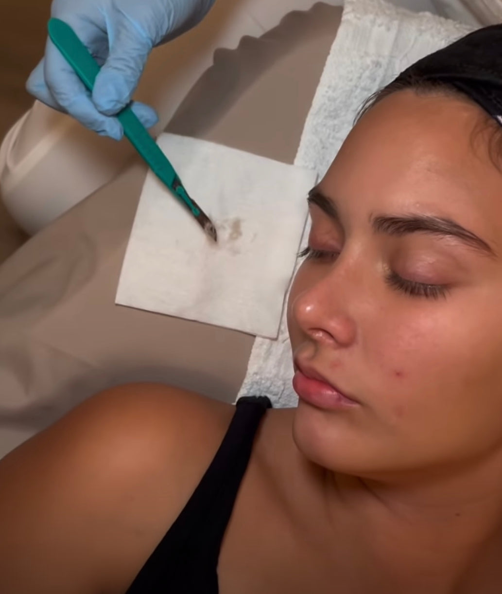 Dermaplaning