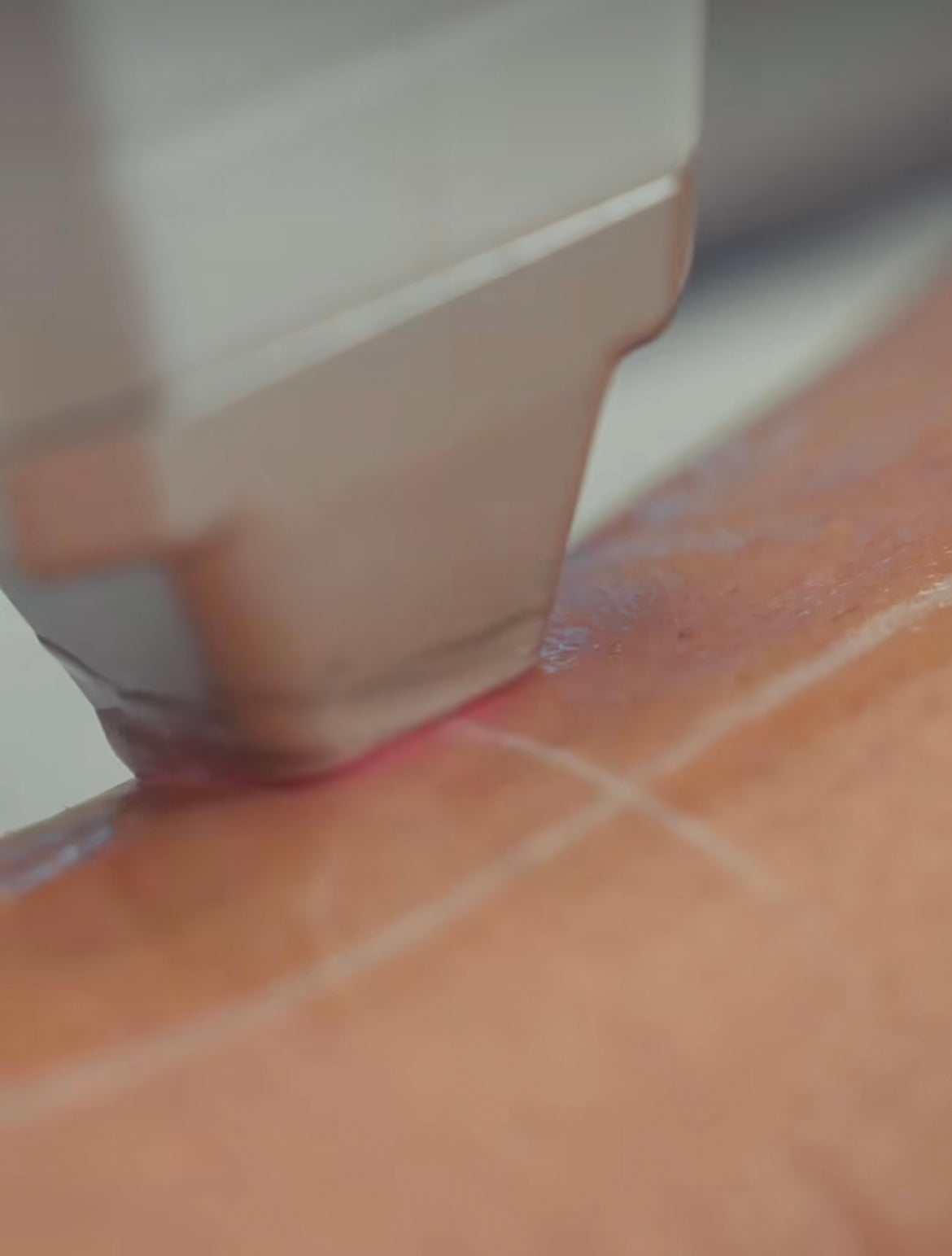 Laser Hair Removal