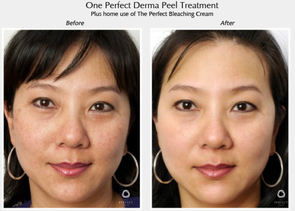 Perfect Derma Peel®