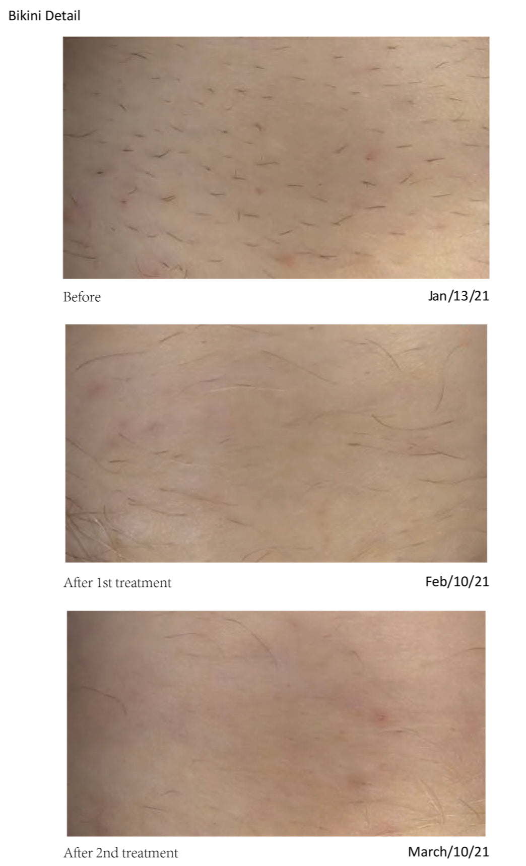 Laser Hair Removal Packages (6 Sessions)