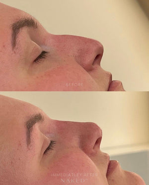Naked Nose | Non-Surgical Nose Job (NSNJ)