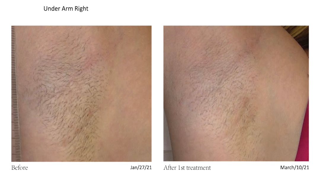 Laser Hair Removal Packages (6 Sessions)