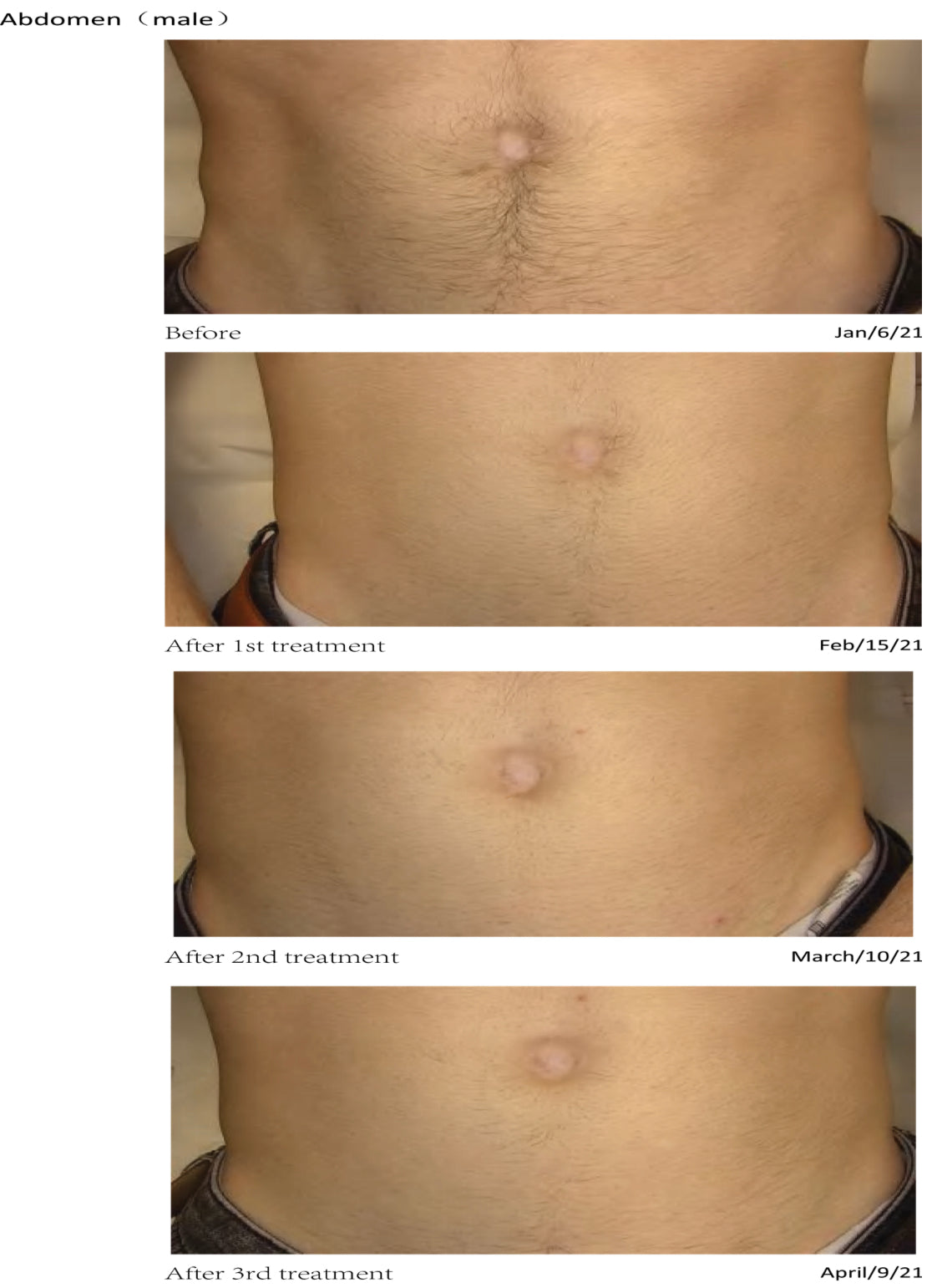 Laser Hair Removal