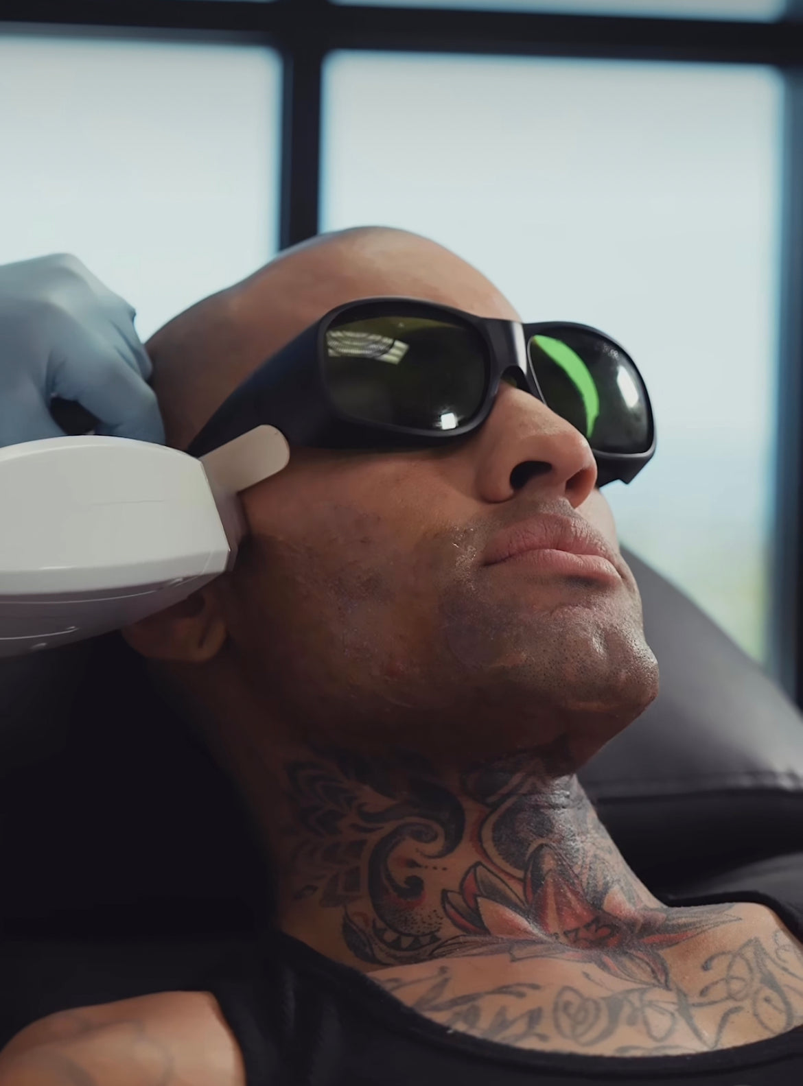 Laser Hair Removal