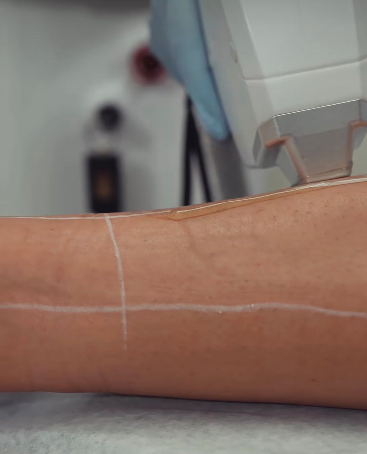 Laser Hair Removal