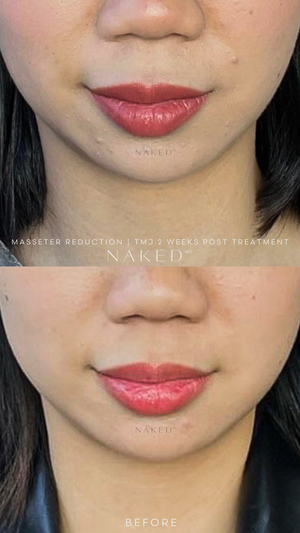 Masseter Reduction | TMJ