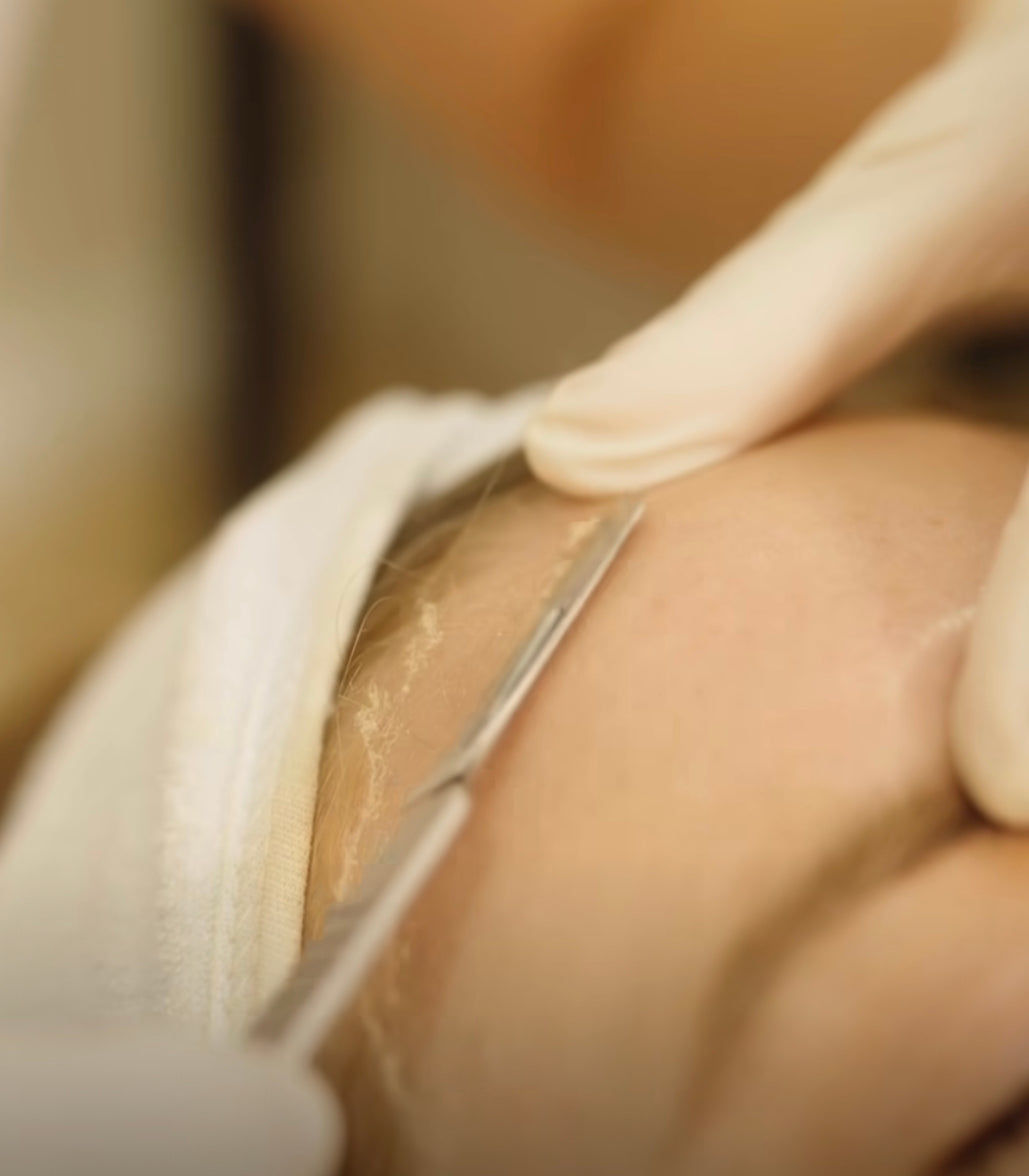 Dermaplaning