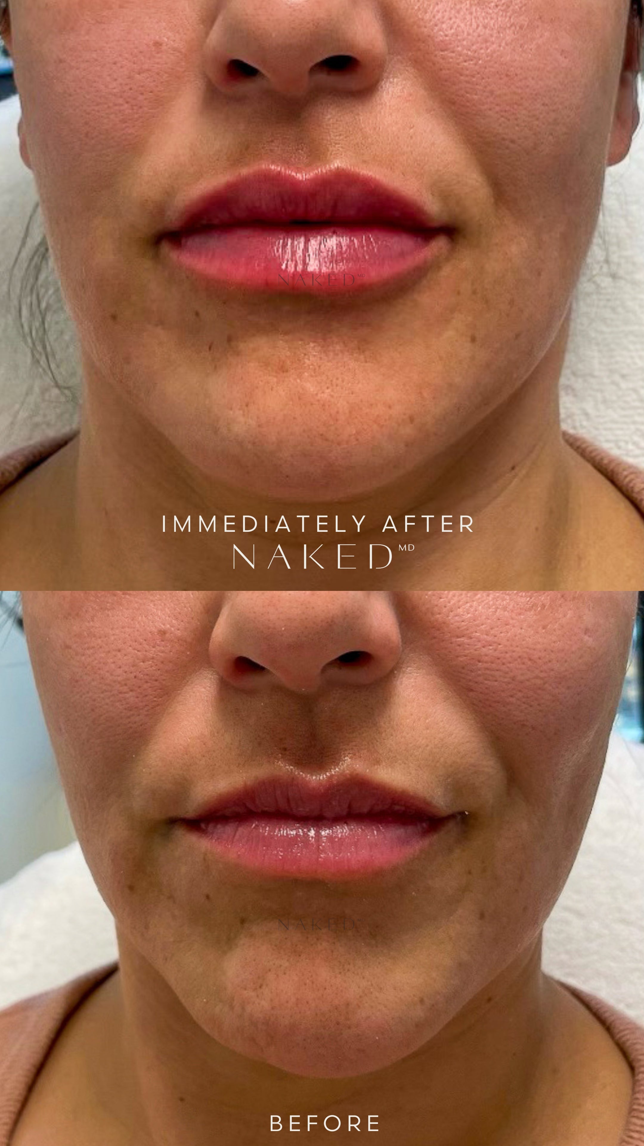 Naked Lips | Lip Filler