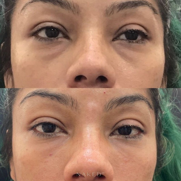 Undereye Filler
