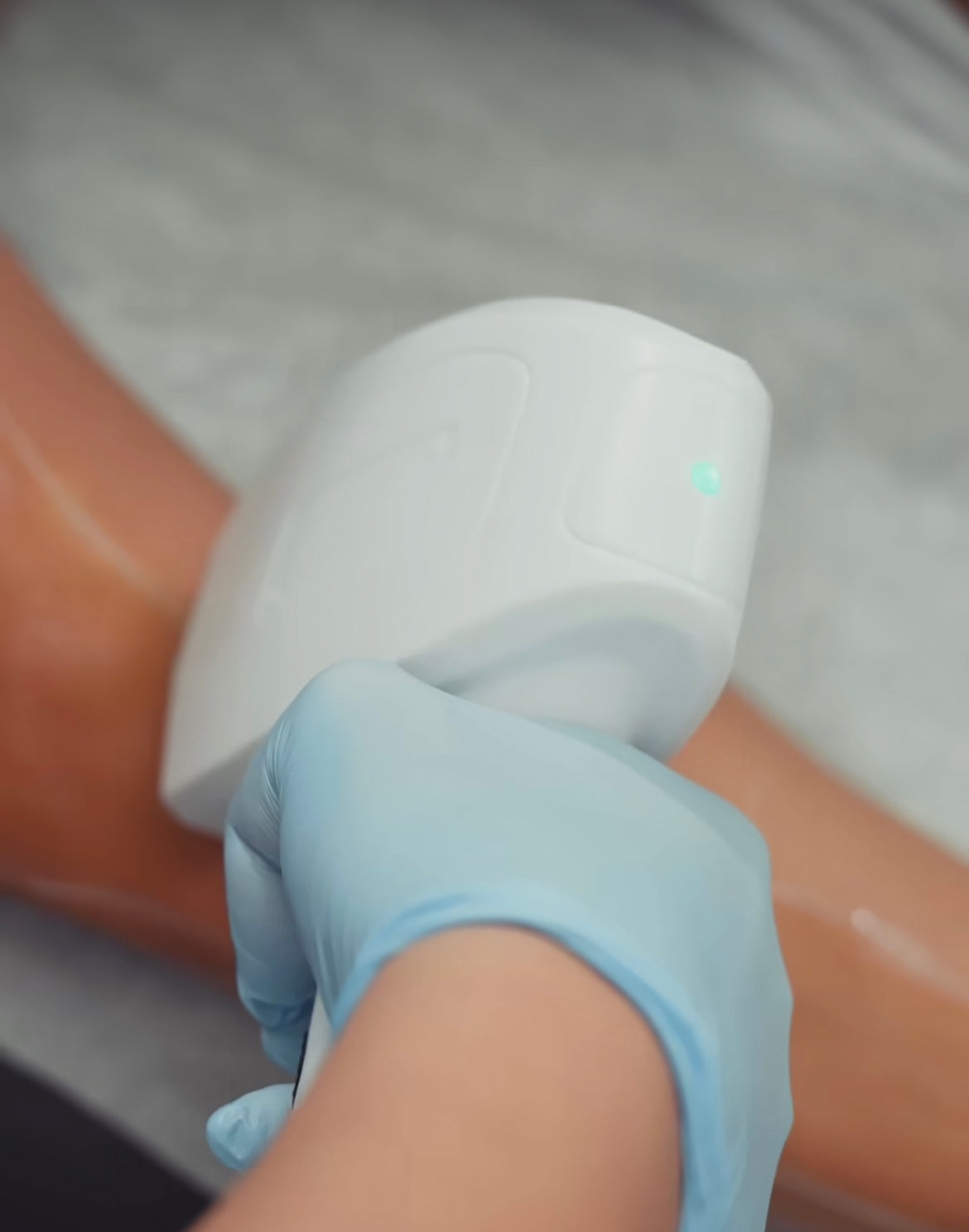 Laser Hair Removal