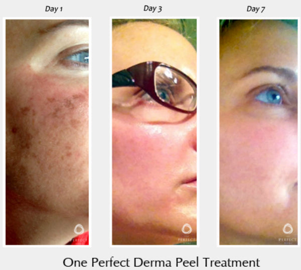 Perfect Derma Peel®