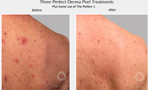 Perfect Derma Peel®