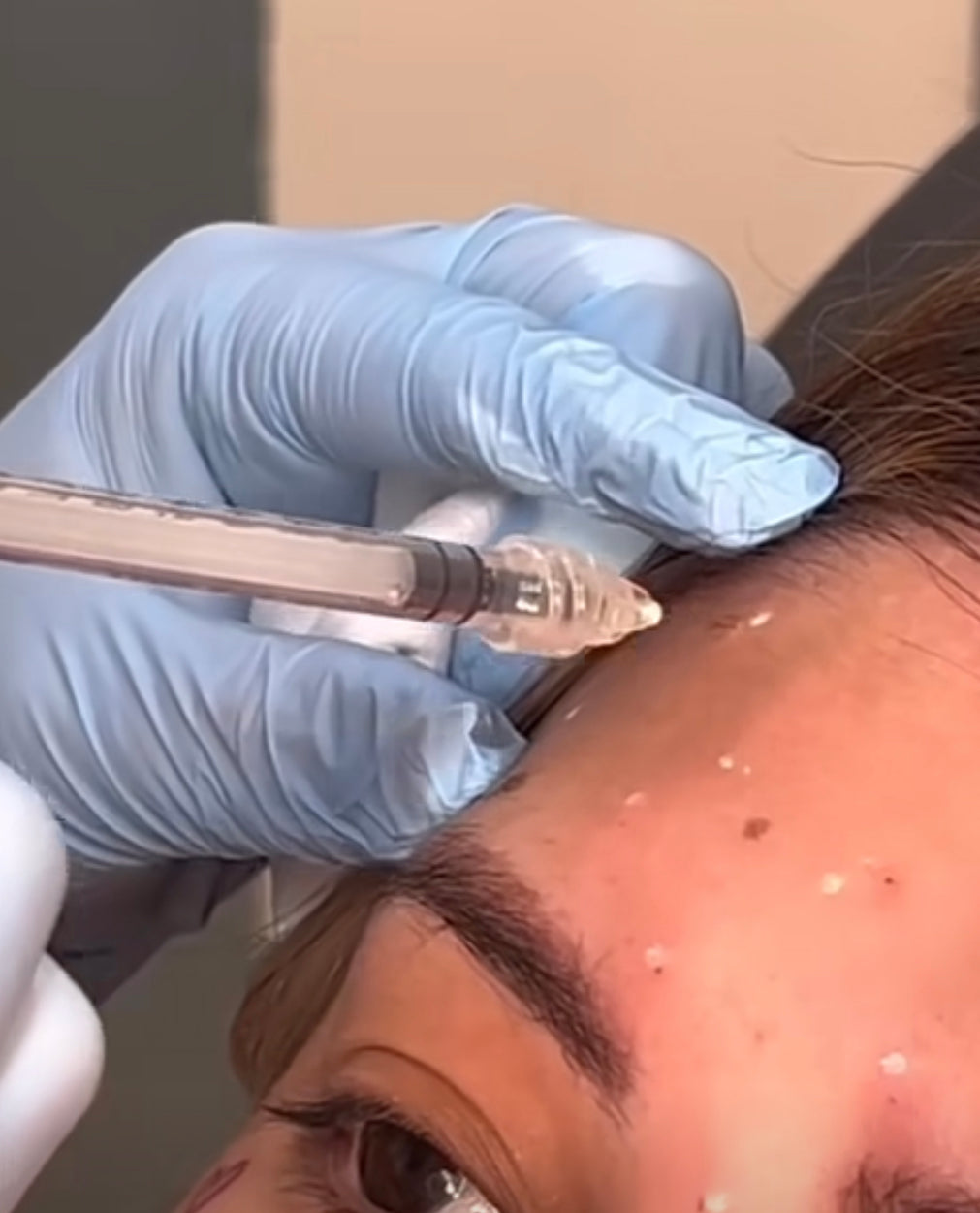 The NAKED Needle