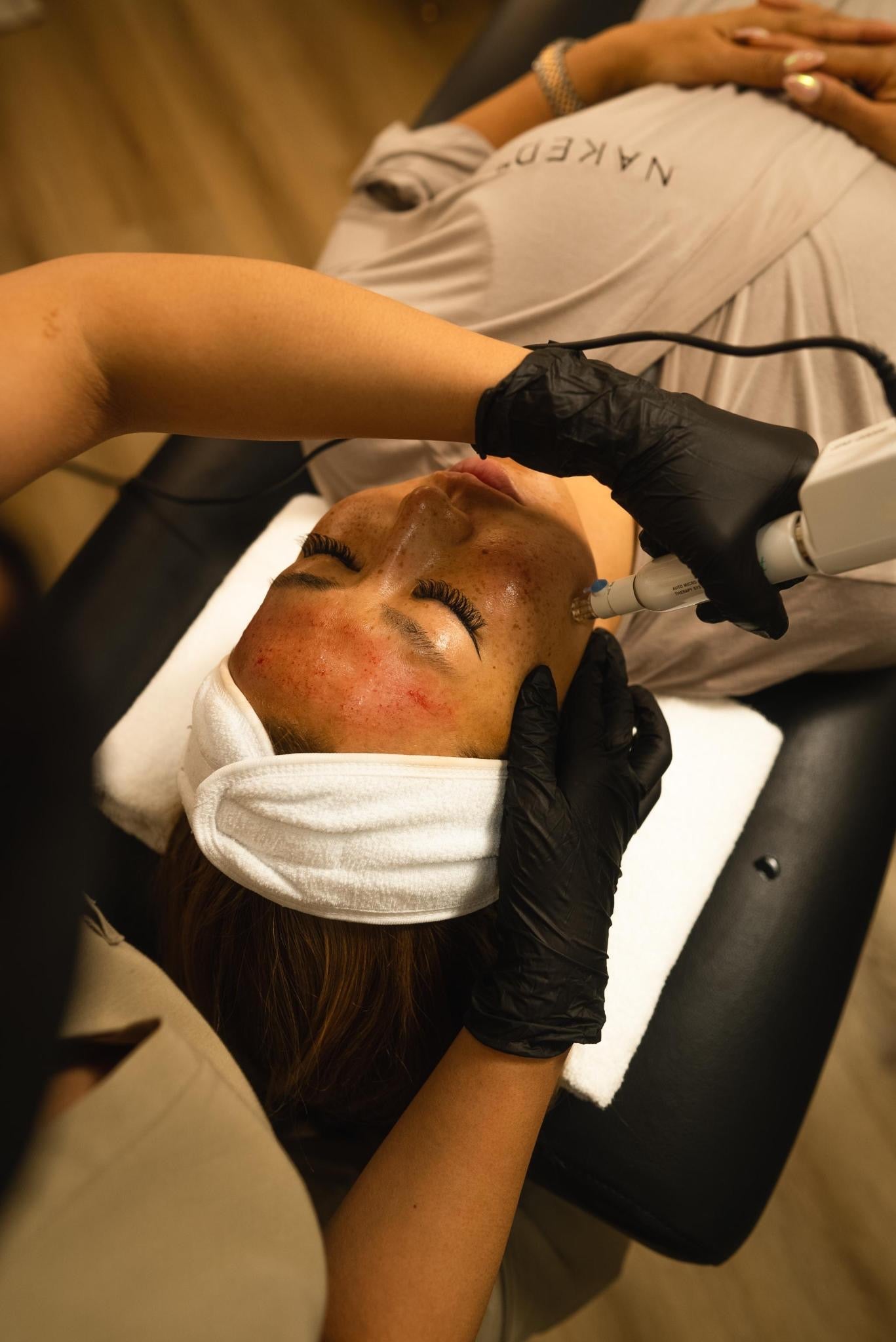 Microneedling w/ SkinPen