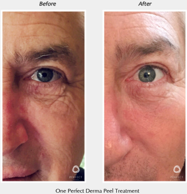 Perfect Derma Peel®