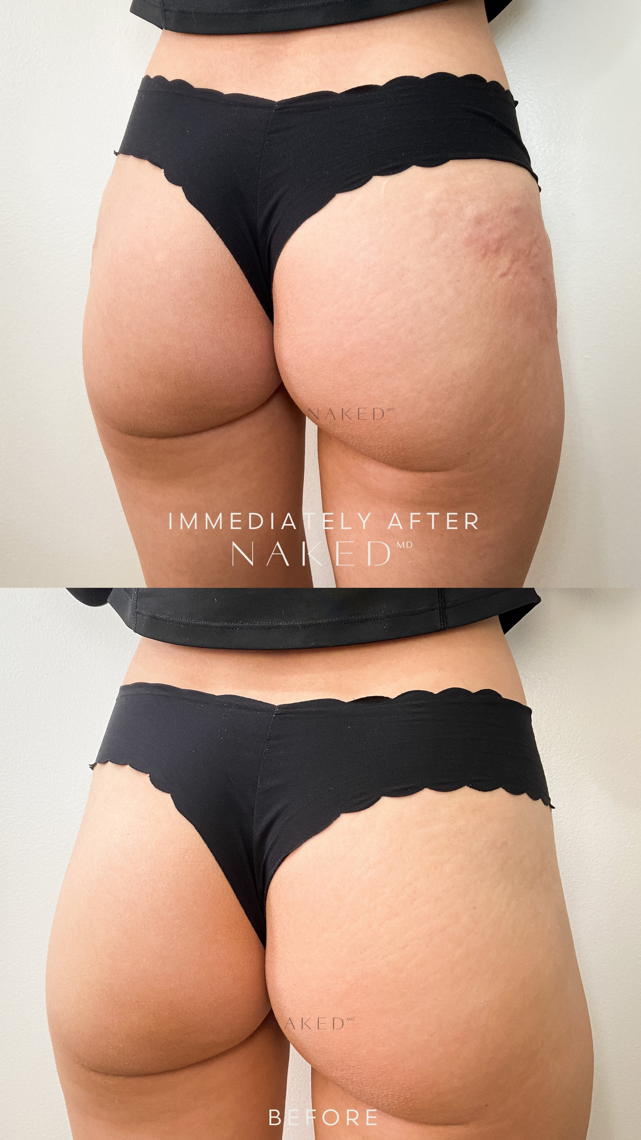 Naked Booty® | Non-Surgical Brazilian Butt Lift (BBL)