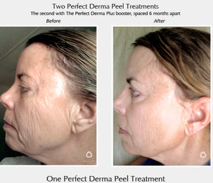 Perfect Derma Peel®