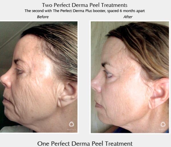 Perfect Derma Peel®