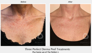 Perfect Derma Peel®