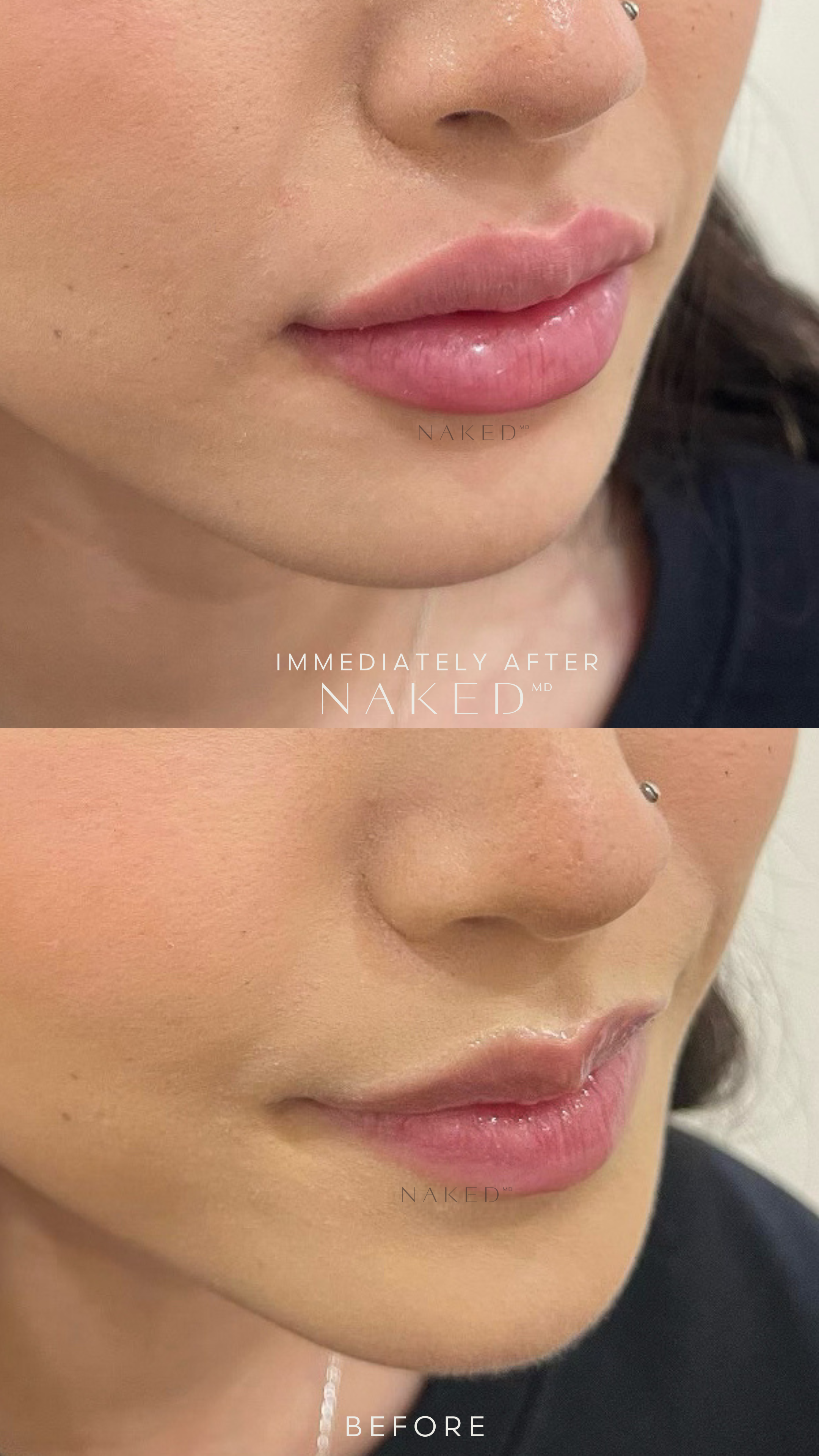 Naked Lips | Lip Filler