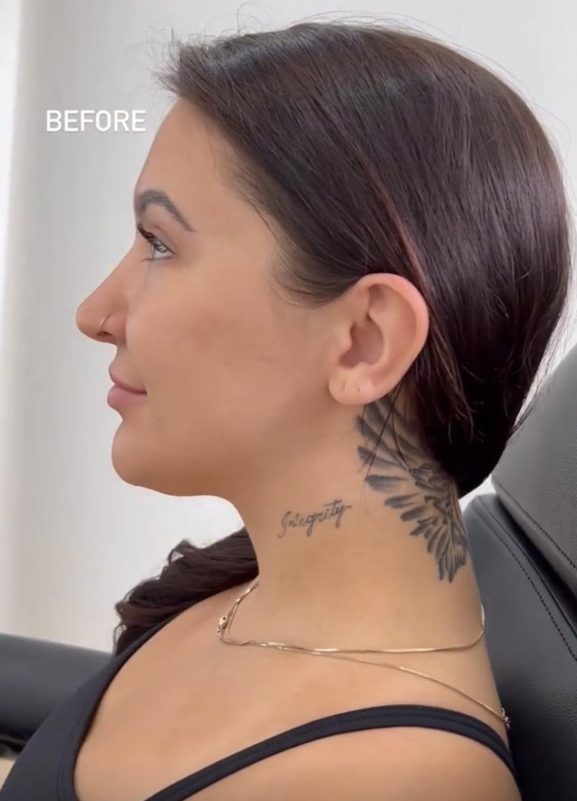 Jawline Contour Filler