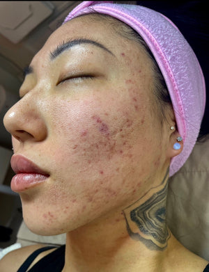 Perfect Derma Peel®