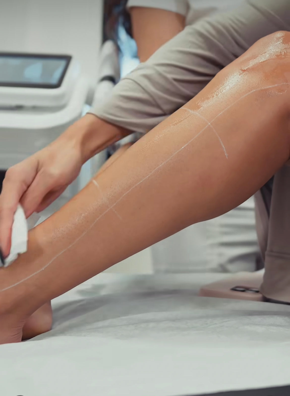 Laser Hair Removal