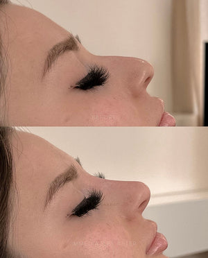 Naked Nose | Non-Surgical Nose Job (NSNJ)