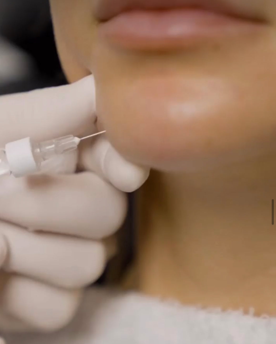 Kybella Treatment