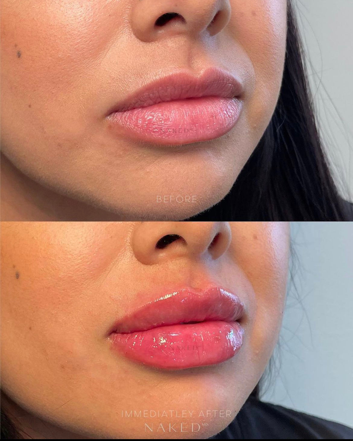 Naked Lips | Lip Filler