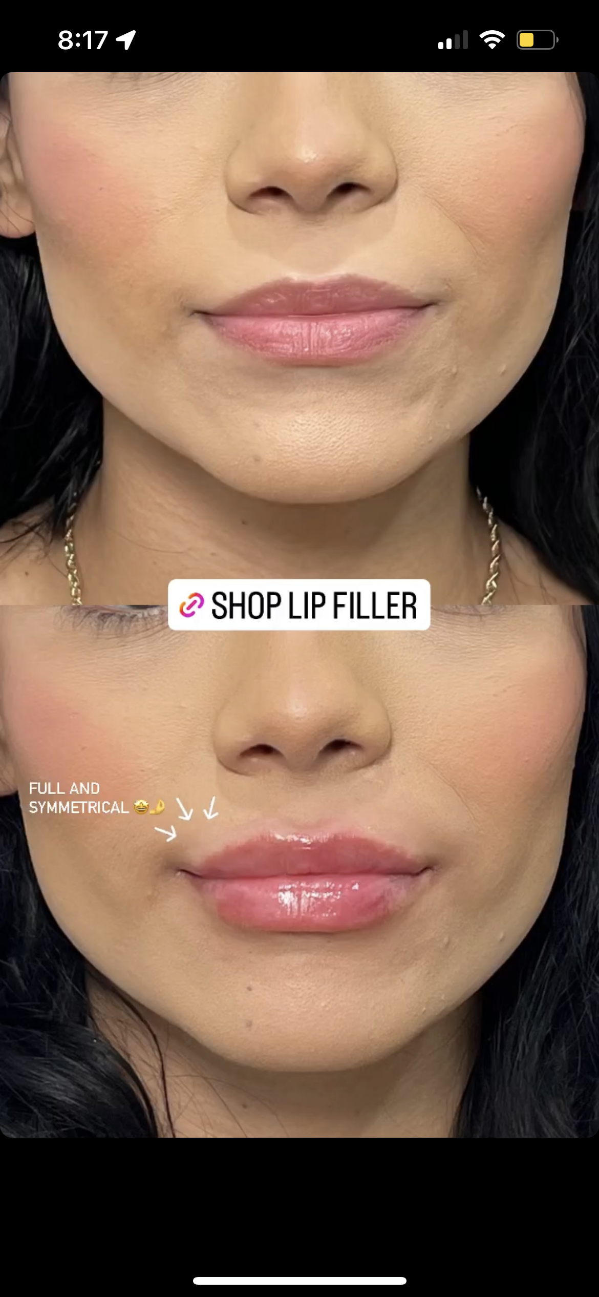 Naked Lips | Lip Filler