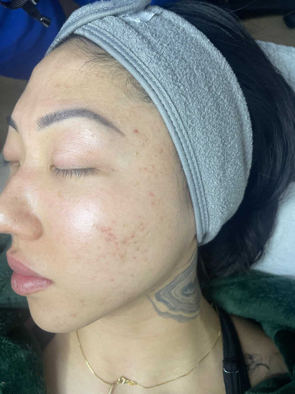 Perfect Derma Peel®