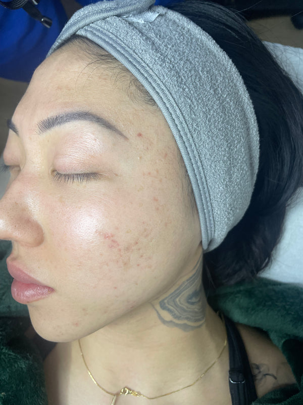 Perfect Derma Peel®