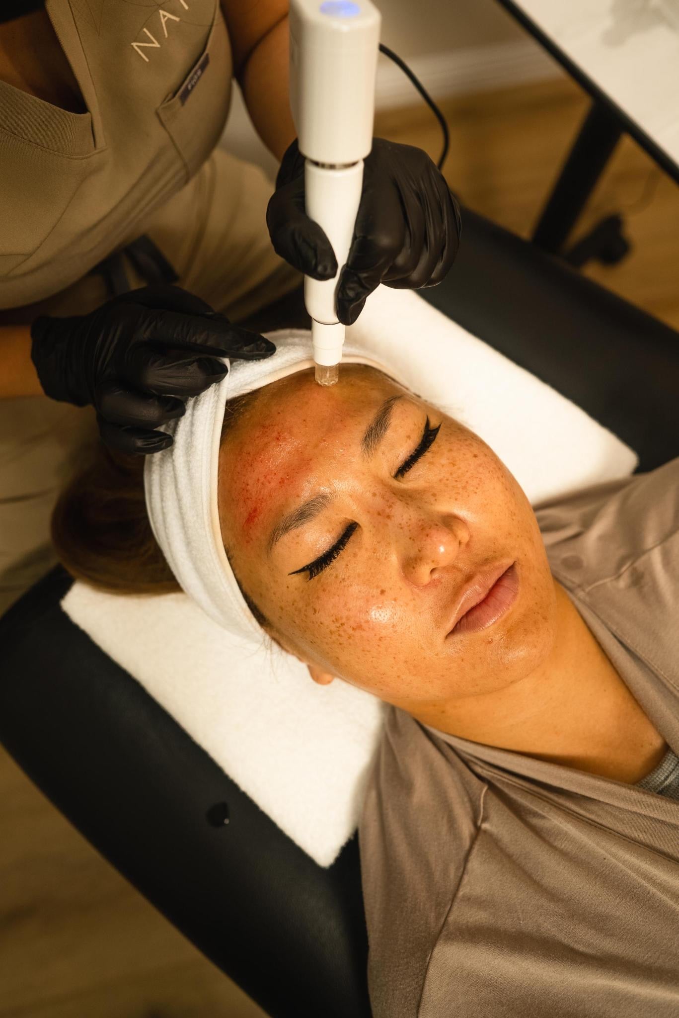 Microneedling w/ SkinPen