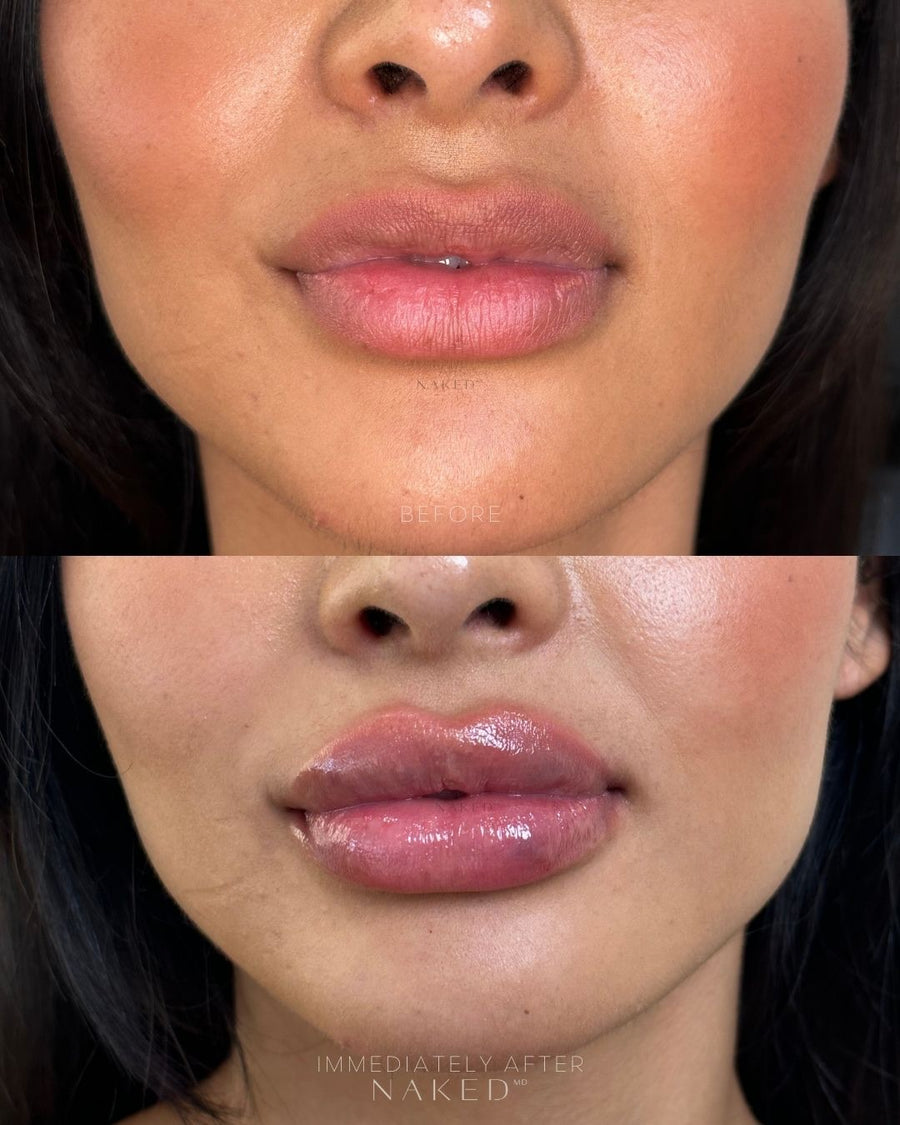 Naked Lips Lip Filler NAKEDMD Medspa