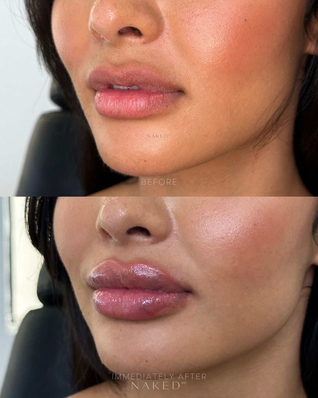 Naked Lips | Lip Filler