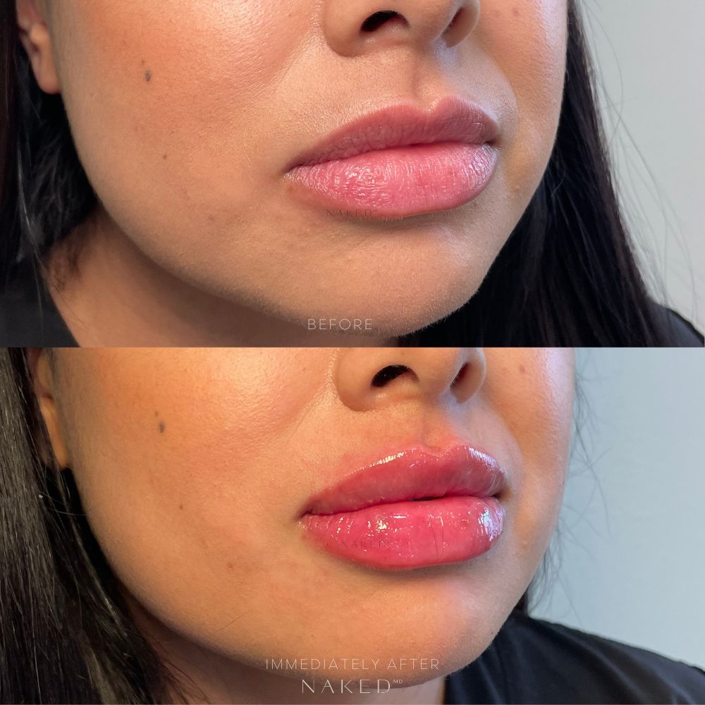 Naked Lips | Lip Filler