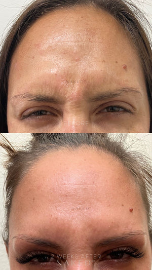 Naked TOX | Neurotoxins